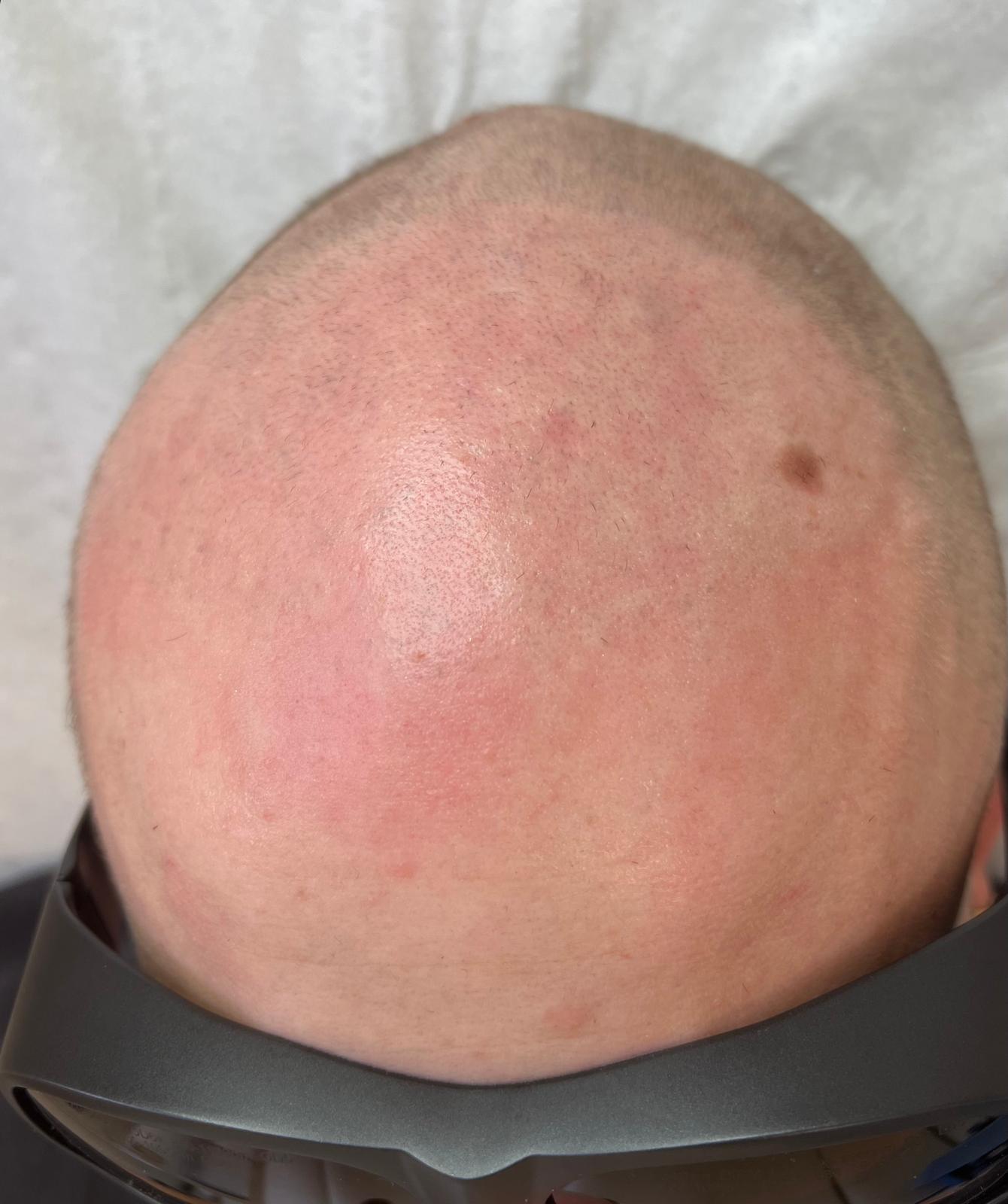 Picoseconde Laser Technologie