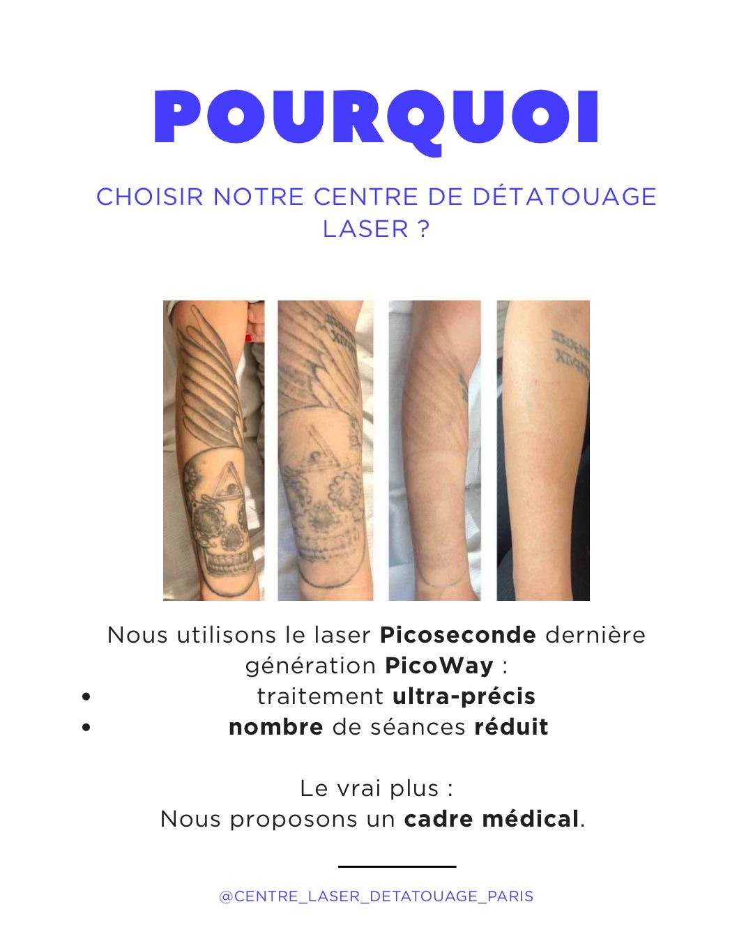 Détatouage à Paris au Picoseconde Technologie