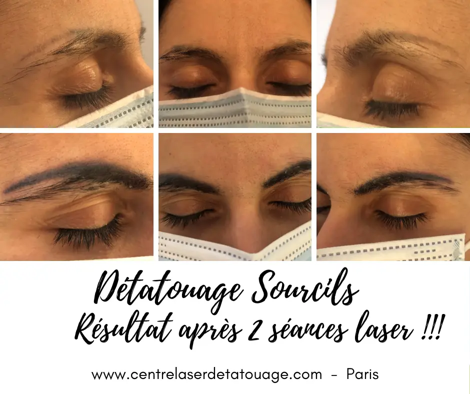 Détatouage à Paris au Picoseconde Laser Technologie