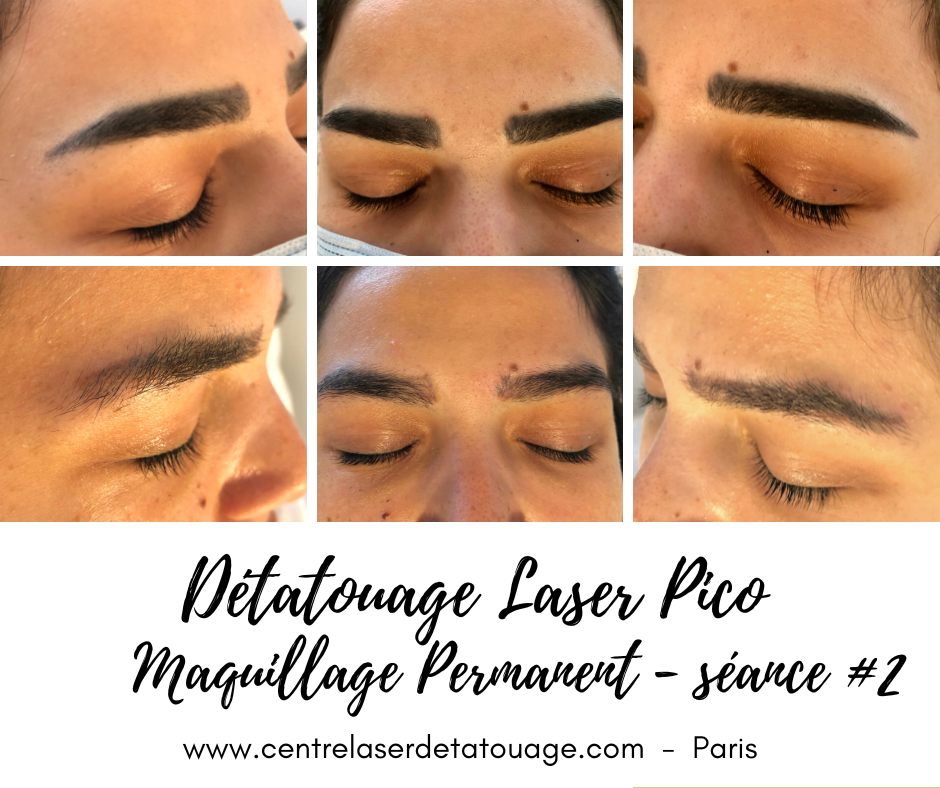 Détatouage à Paris au PicoWay Picoseconde Technologie