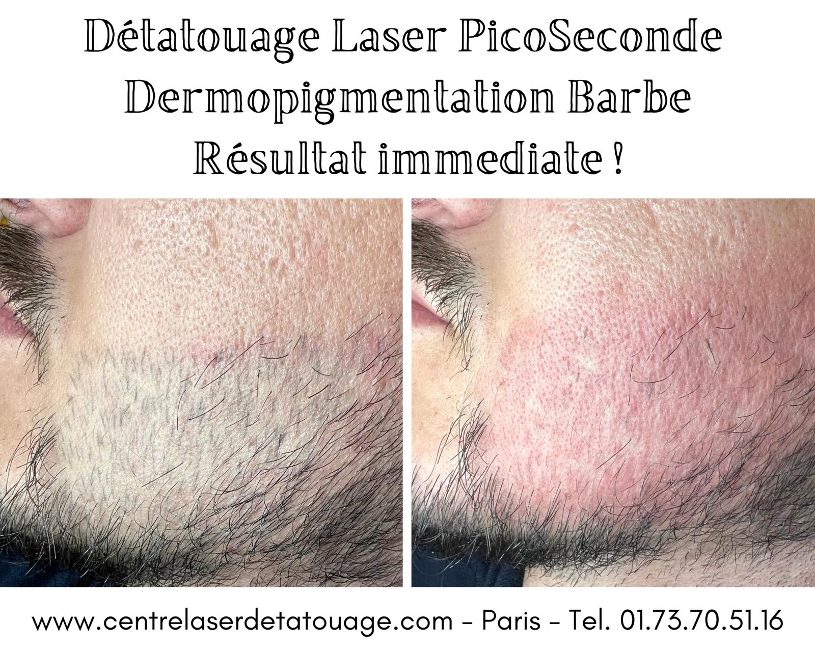 Picoseconde Laser Technologie à Paris 8e