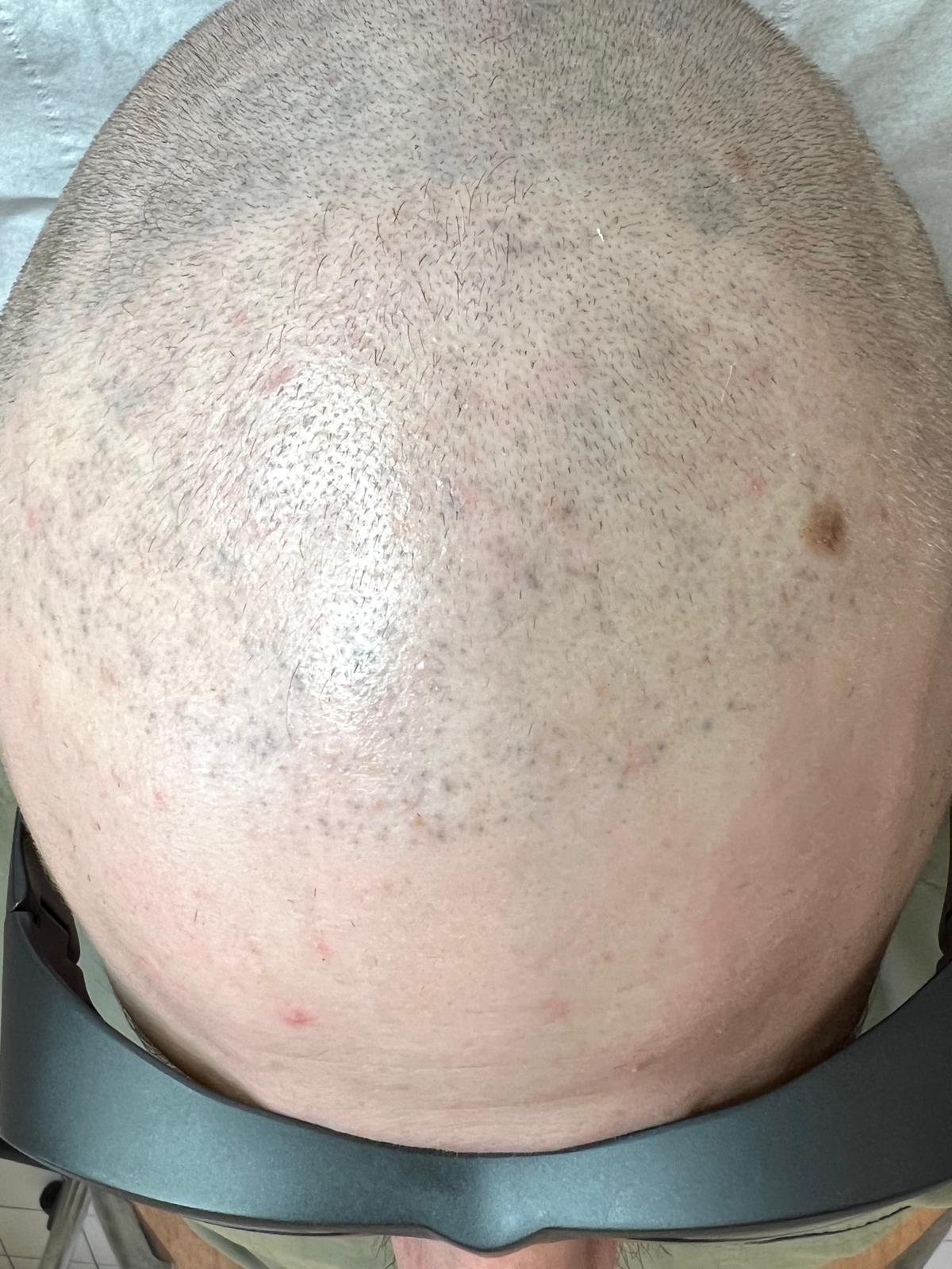 Picoseconde Laser Technologie à Paris