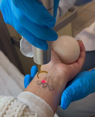 Centre détatouage à Paris