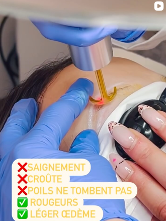 Détatouage centre à Paris