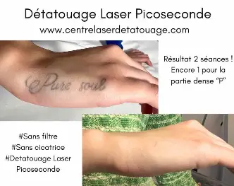 Centre Détatouage au laser picoseconde PicoWay