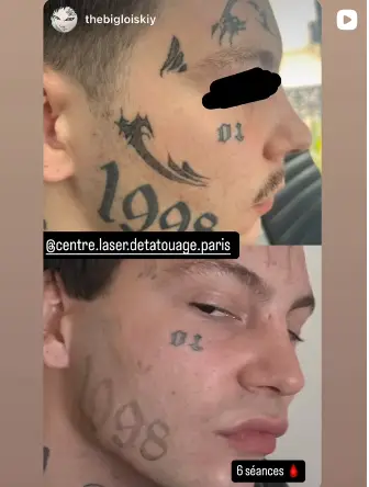 Détatouage sur Visage