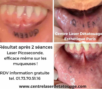 Détatouage service à Paris