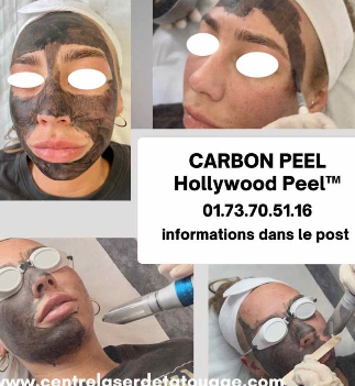 Carbon Peel Paris au laser Détatouage et Esthétiques Centre