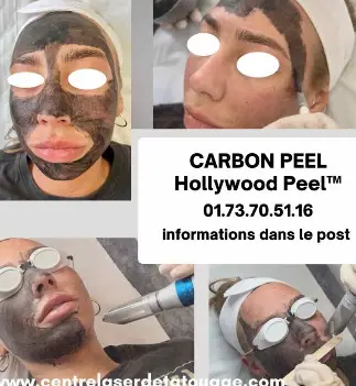 Carbon Peel Paris au Centre Laser Détatouage & Esthétique Paris
