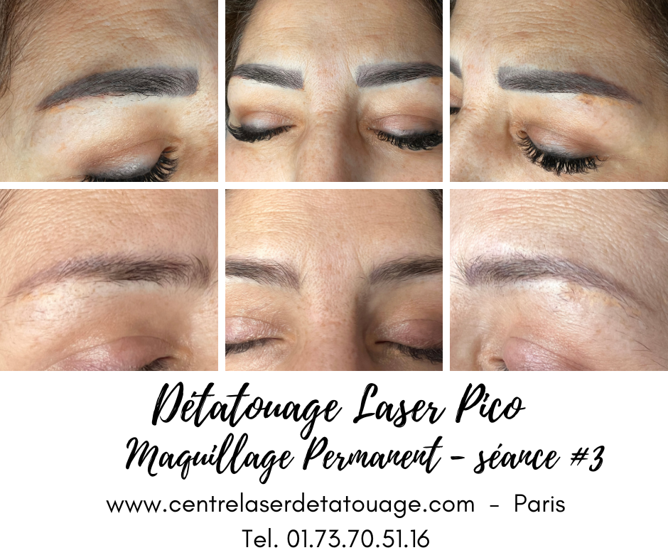 PicoWay Candela Laser Technologie a Paris