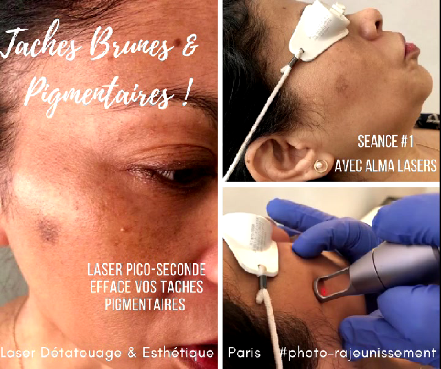 Picoway Technologie à Paris Laser Médicale